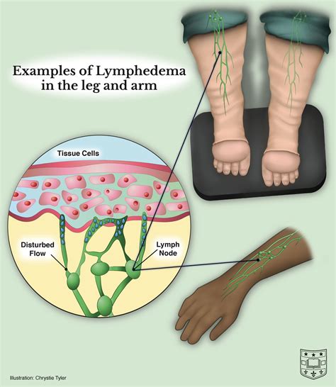 lymph fluid leaking from scalp|Lymphatic Dysfunction (Lymphedema): Symptoms and。